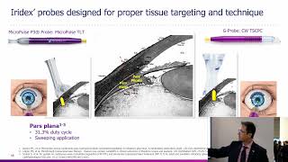 Iridex Academy A Primer on MicroPulse Transscleral Laser Therapy for Glaucoma  Brian Francis MD [upl. by Boleyn]