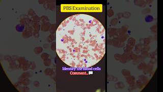 Peripheral Blood Smear  PBS Examination hematology blood bloodtest shorts [upl. by Cletis]