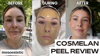 COSMELAN DEPIGMENTATION PEEL  chemical peel for pigmentation  dark spots [upl. by Esinej572]