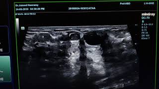 Intraductal Papilloma Sonography [upl. by Connie]