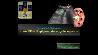 Ultrasound Case 296  Emphysematous Pyelonephritis [upl. by Adnerol]