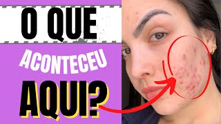 ESPIRONOLACTONA PARA ACNE espinhas HORMONAL TUDO EXPLICADO [upl. by Airamzul900]