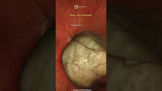 Choroidal Melanoma [upl. by Acireit]