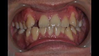 Upper right lateral incisor missing [upl. by Gersham]