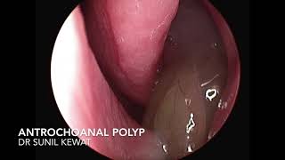 Antro Choanal Polyp  Nasal Endoscopy [upl. by Suilenrac]