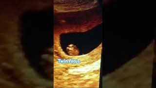 Ultrasound of fetal well being Twin CRL Monochronic amp Monoamnotic youtubeshorts shorts pregnacy [upl. by Kristien]