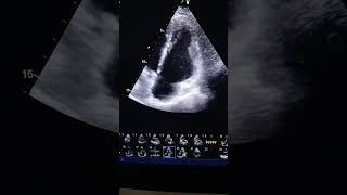 Right ventricular arrhythmogenic cardiomyopathy [upl. by Atiuqam]