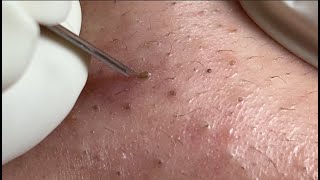 Acne Treatment Huong Da Nang membership 006   2023 [upl. by Martguerita]