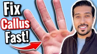 How to Get Rid of Calluses FAST in 5 EASY Steps [upl. by Airdnat176]