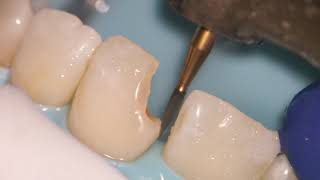 Teeth Bonding  Front tooth filling EXPLAINED [upl. by Zerla]