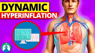 Dynamic Hyperinflation Medical Definition  Quick Explainer Video [upl. by Delija92]