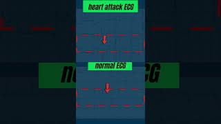 Heart attack ECG l IWMI l ecg echo angiography shorts [upl. by Knowlton373]