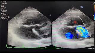 Endocardial Cushion Defect  Rastelli type C [upl. by Erine]