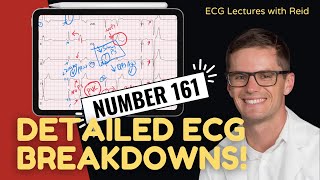 EKG Test Yourself  ECG Case Study 161 [upl. by Adilem]