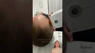 laser hair removal laser hair removal at home laser hair removal before and after laser hair [upl. by Marcile]