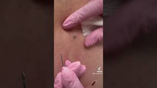 Blackhead pop [upl. by Desi]