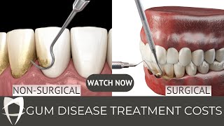 Periodontal disease  Periodontitis  Gingivitis  Treatment Fees [upl. by Muldon]