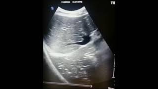 Ultrasound of pneumonitis with Hepatization of lung [upl. by Christiana]