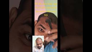 Hair kaise ugya full treatment90 din result haircare baalkaiseugaye hairgrowthtreatment [upl. by Ayim]