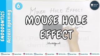 Mouse hole effect  RCT  Access Opening  Dr Paridhi Agrawal [upl. by Asilram294]