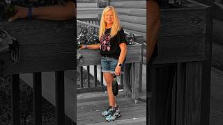 76 Surgeries Later… Dana walks with purpose prosthetics Limblab bioniclimbs [upl. by Terrab960]