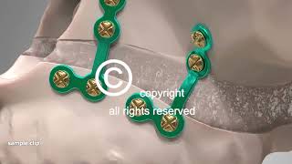 Corrective Jaw Surgery Orthognathic  Animation [upl. by Hadleigh]