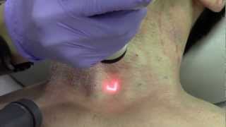 CO2 Laser For The Neck [upl. by Sanoj]