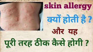 Allergy  urticaria पित्ती  क्यों होती हैं और इसका जड़ से इलाज कैसे होगा [upl. by Lhary680]