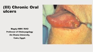 III Chronic Oral Ulcers [upl. by Amuwkuhc]