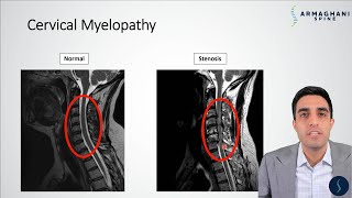 Cervical Myelopathy  What is it How can we treat it [upl. by Enawd898]