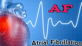 Atrial Fibrillation  Amiodarone  CHADS2 VASC Score [upl. by Richy]