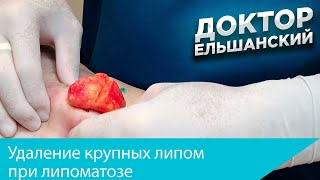 Удаление крупных липом при липоматозе Removal of lipomas in multiple lipomas lipomatosis [upl. by Shultz]