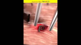 How do ingrown hairs grow [upl. by Alyose484]