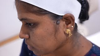 Ear Keloid Removal Procedure [upl. by Finzer]