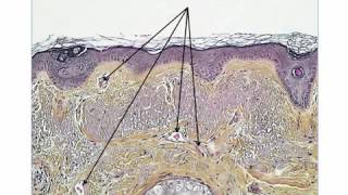 2 new dermoscopic criteria for LMM on the face by Dr Luc Thomas [upl. by Gonta440]