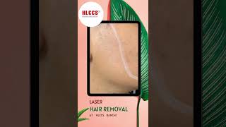 Laser Hair removal at HLCCS RANCHICall now 9334334935 laserhairremoval skincare laser [upl. by Tad484]