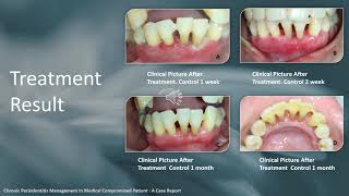 Chronic Periodontitis Management In Medical Compromised Patient  A Case Report [upl. by Pilar]