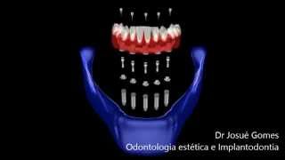 Dentadura Fixa Protocolo de Branemark [upl. by Steiner529]