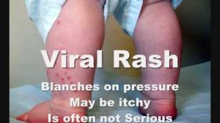 How To Check Meningitis Rash [upl. by Grossman]