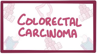 Colorectal carcinoma  causes symptoms diagnosis treatment pathology [upl. by Cira]