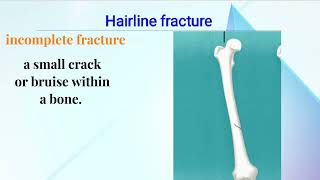 Types Of Fractures  Bone  Orthopedic  orthopedics ms fcps doctor fracture [upl. by Sitruk]