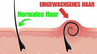 Was sind eingewachsene Haare – und wie werden sie behandelt [upl. by Susej]