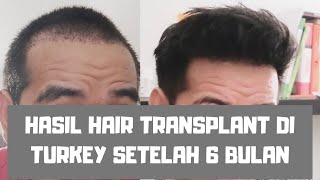 HASIL TRANSPLANTASI RAMBUT 6 BULAN [upl. by Fein187]