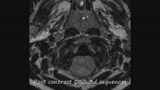 The plastic monster ependymoma how do you deal with this brain tumor in a six year old child [upl. by Yetti481]