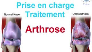 Traitement de lArthrose douleur cervicale du genou How to treat osteoarthritis [upl. by Airetnahs]