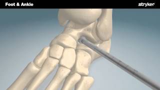 Stryker Foot and Ankle  SubFix™ Arthroeresis Implant Animation [upl. by Wachtel]