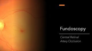 Central Retinal Artery Occlusion CRAO Fundoscopy [upl. by Alrak]