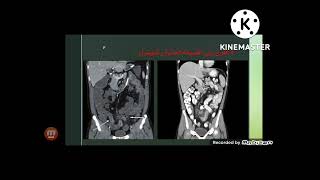 CT ENTEROGRAPHY كيفية عمل فحص اشعة مقطعية علي الامعاء [upl. by Blunk426]