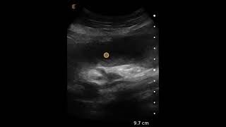 Small Bowel Obstruction  Ultrasound Image Interpretation [upl. by Ayalahs]