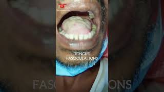 Tongue Fasciculations  Motor Neuron Disease  Dr Shankar Dey [upl. by Yerg]